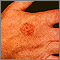 Bowen's disease on the hand Bowen's disease on the hand