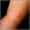 Ringworm - tinea corporis on an infant's leg