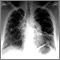 Sarcoid, stage IV - chest x-ray Sarcoid, stage IV - chest x-ray