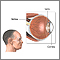 CMV retinitis CMV retinitis