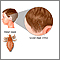 Head lice
