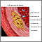 Enlarged view of atherosclerosis