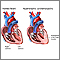 Hypertrophic cardiomyopathy