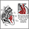 Mitral valve prolapse Mitral valve prolapse