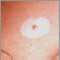 Halo nevus Halo nevus