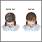 Female-pattern baldness Female-pattern baldness