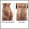 Liposuction - series - Indications Liposuction - series - Indications