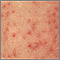 Keratosis pilaris - close-up Keratosis pilaris - close-up