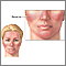 Rosacea Rosacea