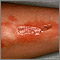 Necrobiosis lipoidica diabeticorum - leg