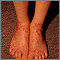 Atopy on the ankles Atopy on the ankles