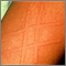 Dermatographism on the arm Dermatographism on the arm