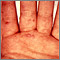 Hand, foot, and mouth disease on the hand Hand, foot, and mouth disease on the hand