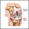 Knee joint replacement - Series Knee joint replacement - Series