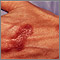 Mycobacterium marinum infection on the hand