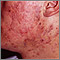 Acne - cystic on the face