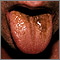 Black hairy tongue Black hairy tongue