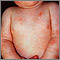 Dermatitis - atopic in an infant Dermatitis - atopic in an infant