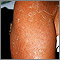 Exfoliation following erythroderma Exfoliation following erythroderma