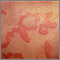 Hives (urticaria) - close-up Hives (urticaria) - close-up
