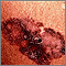 Skin cancer - melanoma superficial spreading