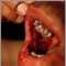 Pemphigus vulgaris - lesions in the mouth