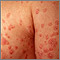 Psoriasis - guttate on the arms and chest Psoriasis - guttate on the arms and chest
