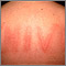 Dermatographism on the back Dermatographism on the back