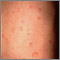 Hives (urticaria) on the back Hives (urticaria) on the back