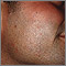 Molluscum contagiosum on the face