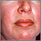 Dermatomyositis - heliotrope rash on the face