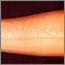 Dermatographism - arm Dermatographism - arm
