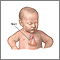 Patent ductus arteriosis (PDA) - series - Infant heart anatomy