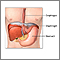 Hiatal hernia repair - series