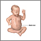 Omphalocele repair - series Omphalocele repair - series