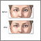 Before and after strabismus repair Before and after strabismus repair