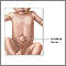 Umbilical hernia Umbilical hernia