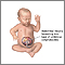 Infant omphalocele Infant omphalocele
