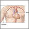 Cardiac arteriogram Cardiac arteriogram