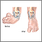 Clubfoot deformity Clubfoot deformity