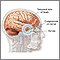 Brain herniation Brain herniation