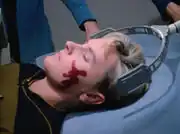 Direct reticular stimulation