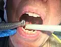 High volume suction, right, with a pneumatic dental drill, left.