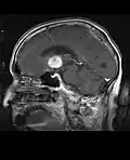 MRI T1 Sagittal