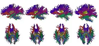 High-dimensional white matter atlas generation and group analysis: result of automatic segmentation of novel subjects.