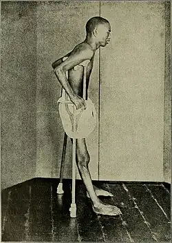 Filipino man riddled with beriberi contracted in a U.S. Army concentration camp during the Philippine–American War, 1902[citation needed]