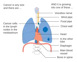 Stage IIIB lung cancer
