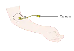 Diagram showing a cannula