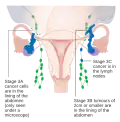 Stage 3 ovarian cancer
