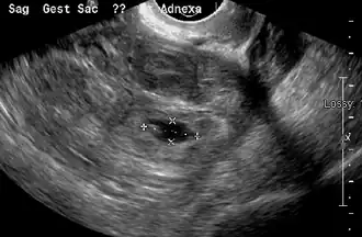 Ultrasound image showing an ectopic pregnancy where a gestational sac and fetus have been formed